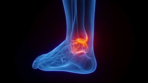 Posterior Ankle Impingement Causes Symptoms And Treatment