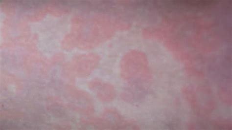 Hives: Causes, Risks, Prevention, and Pictures