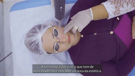 Tratamento Para Olheiras Zye Laser Youtube