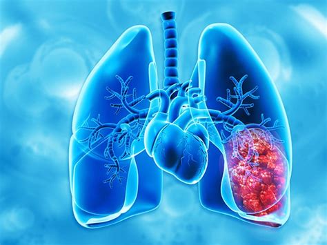 Amivantamab Plus Chemo Approved For Some EGFR Mutated Lung Cancers