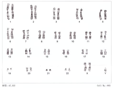 Klinefelter syndrome - Wikipedia