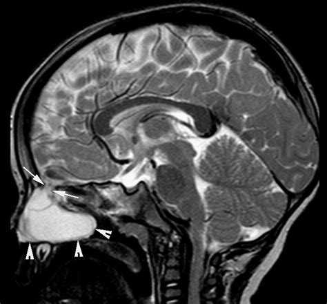 Nasal Polyps Mri