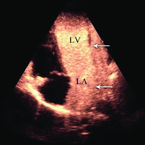 Transthoracic Echocardiography In The Suprasternal Notch View Showing