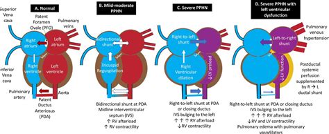 Management Of Systemic Hypotension In Term Infants With Persistent