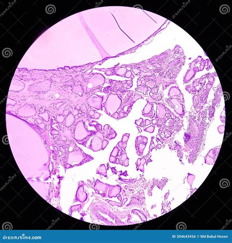 Thyroid Cancer Tracheal Gland Involved By Tumor Microscopic Image Of