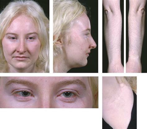 Oculocutaneous Albinism 1