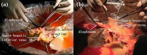 Supra Hepatic Inferior Vena Cava Trimming A Mat Group B Manual Group