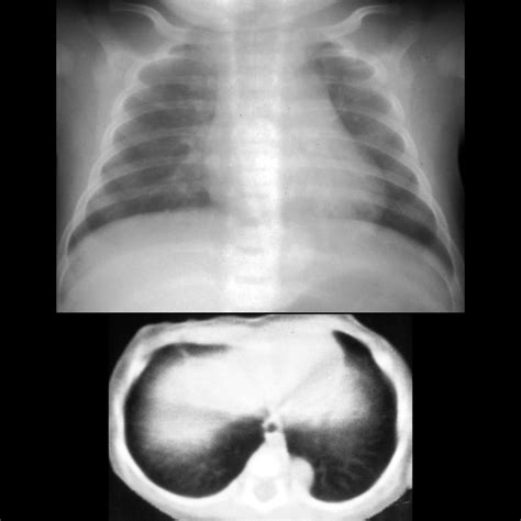 Pulmonary Sequestration | Pediatric Radiology Reference Article ...