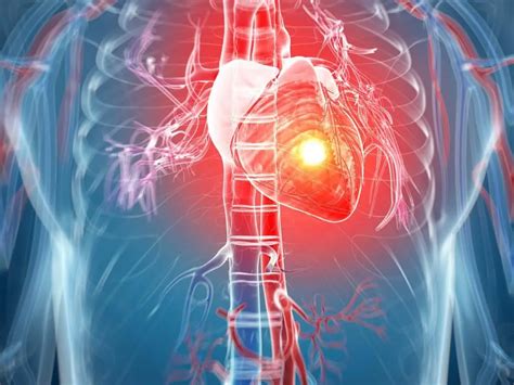 Myocardial infarction: causes, diagnosis, symptoms and treatment | Health 2025