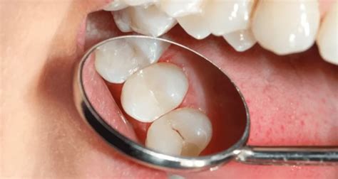 Apiñamiento Dental Identifica las 4 Posibles Causas