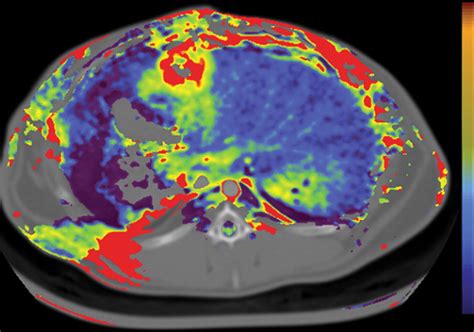 CT Color Mapping Of The Arterial Enhancement Fraction Of VX2 Carcinoma