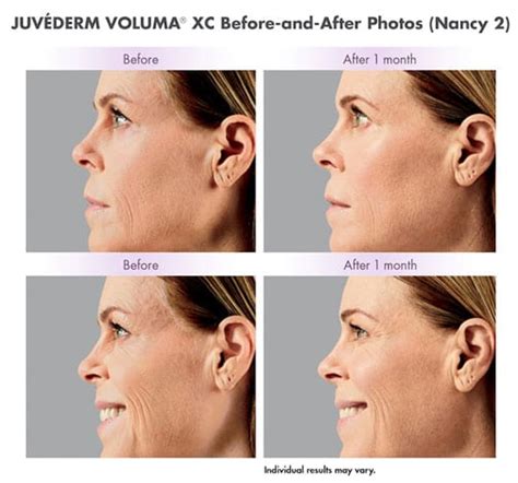 Juvederm Voluma XC - Filler for Cheeks - Bellevue, Kirkland, Issaquah ...