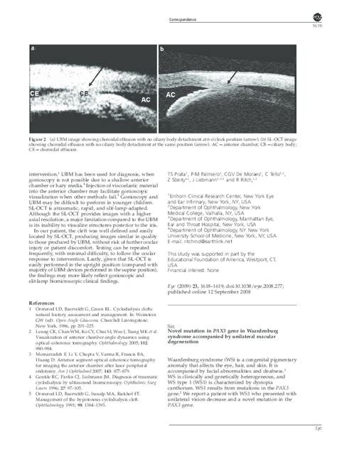 Pdf Novel Mutation In Pax3 Gene In Waardenburg Syndrome Accompanied By Unilateral Macular