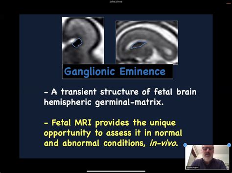 Germinal Matrix Histology