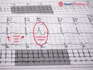 Palpitations and Ventricular Ectopics: Causes, Symptoms, and Management ...