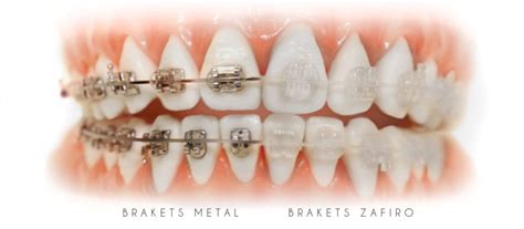 Tipos De Brackets Dental Care Barcelona Dentista En El Eixample