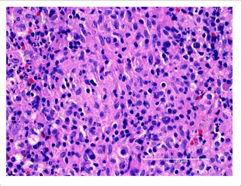 Histology Sample Of The Intrathoracic Mass Showing Granulomatous Download Scientific Diagram