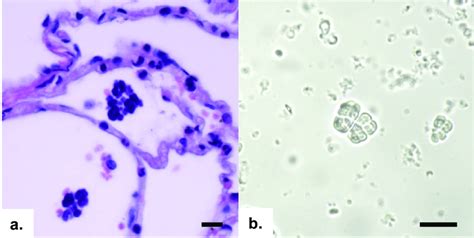 Characteristic Cuboidal Packets Of Sarcina Like Organisms In Tissues Of