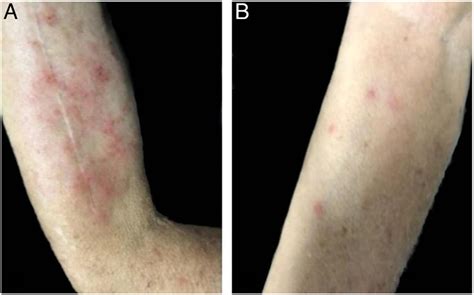 Scielo Brasil Case For Diagnosis Erythematous And Pruritic Papules