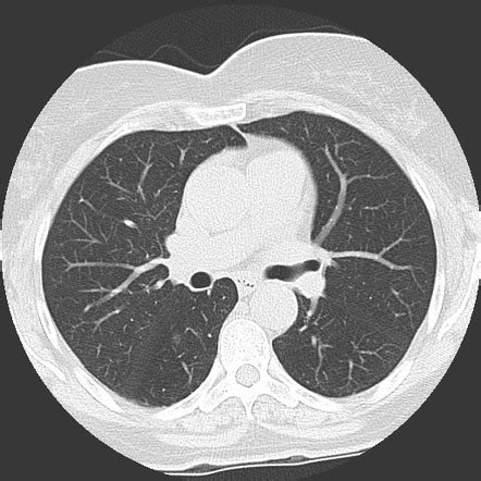 Ground-glass density nodule | Radiology Reference Article | Radiopaedia.org