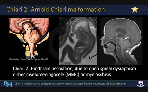 Arnold Chiari Malformation Mri Images