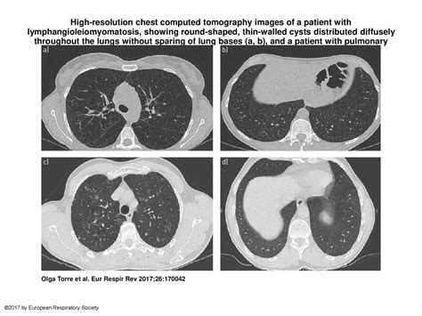 High Resolution Chest Computed Tomography Images Of A Patient With