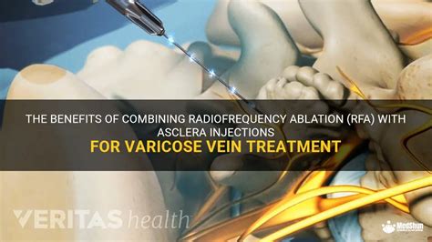 The Benefits Of Combining Radiofrequency Ablation Rfa With Asclera