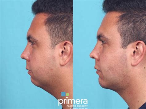 Buccal Fat Removal Before And After Photo Gallery Orlando And Tampa Florida Primera Plastic