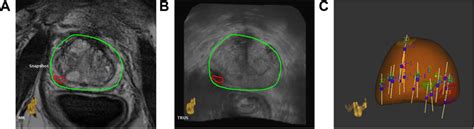 Depiction Of Mrius Fusion A And B Show Axial Slices Of Fused Mr