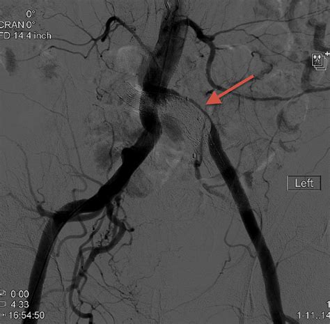 Iliac Artery Stenosis Complicating Iliac Vein Stenting In A Patient With A History Of Radiation