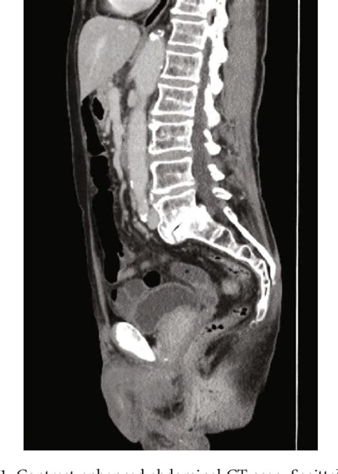 Figure 1 From Rare Anal Canal Cancer With Secondary Extramammary Paget