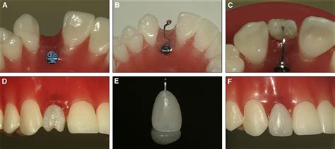 Semipermanent Replacement Of Missing Maxillary Lateral Incisors By Mini