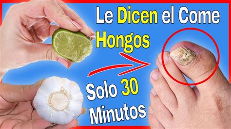 Con Usarlo 1 Vez Al Día Podrás Quitar Los Hongos De Las Uñas De Los Pies Rápidamente Youtube