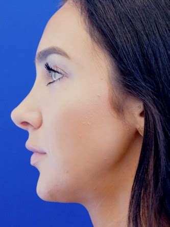 Nasal Hump Closed Rhinoplasty