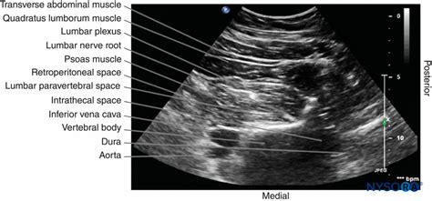 Regional Anesthesia Transverse Sonogram Of The Lumbar Paravertebral