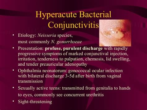 Bacterial Conjunctivitis Treatment Guidelines - slideshare