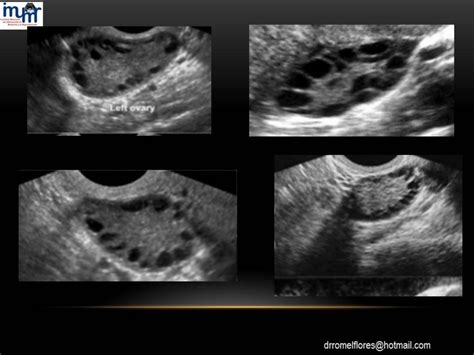 Ultrasonido En Los Tumores De Ovario Dr Romel Flores Imumr