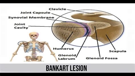 Bankart Lesion A Tear In The Labrum Of The Shoulder Joint Youtube