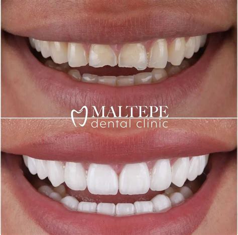 The Teeth Reshaping Procedure What To Expect Maltepe Dental Clinic