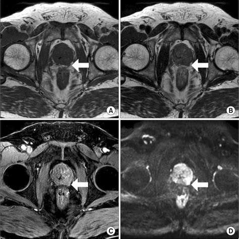 Detection Rates Of Prostate Cancer Of T1 Weighted T2 Weighted And