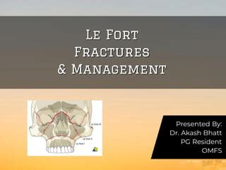 Le Fort Fractures Ppt