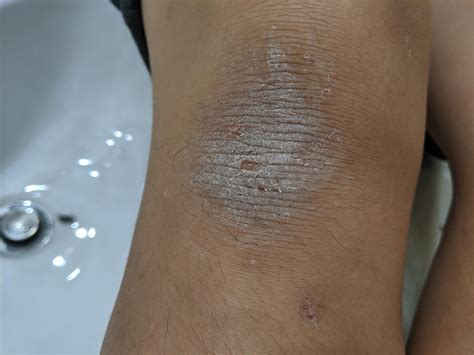 Why Do I Have Dry Hard Skin On Feet at Nick Lopez blog