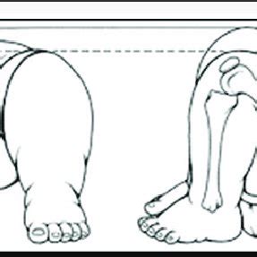 A. Image Showing the Barlow and B. Ortolani Test. | Download Scientific ...