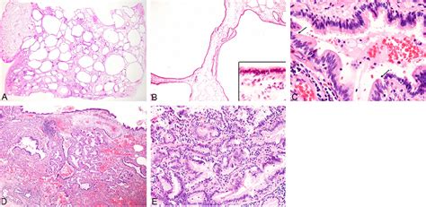 Figure 2 From Mucinous Bronchioloalveolar Carcinoma With K Ras Mutation Arising In Type 1