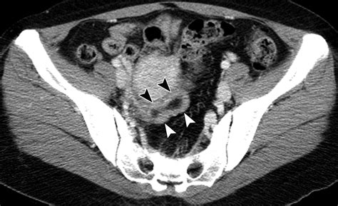 Case 156 Inverted Meckel Diverticulum Radiology