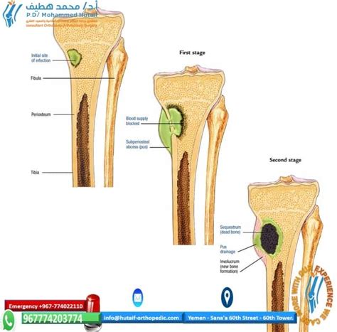 Orthopaedic Infections And Osteomyelitis