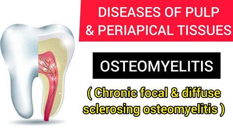 Osteomyelitis Chronic Focal And Diffuse Sclerosing Osteomyelitis