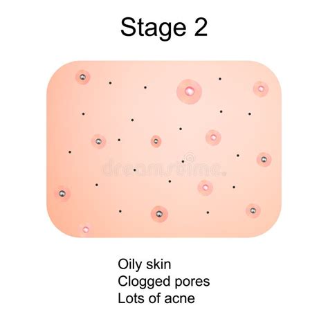 Fase Di Sviluppo Di Acne Pelle Infiammata Con Le Cicatrici L Acne Ed