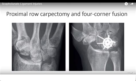 Scapholunate Ligament Injuries — OrthopaedicPrinciples.com