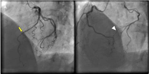 Cardiac Angiogram Anatomy